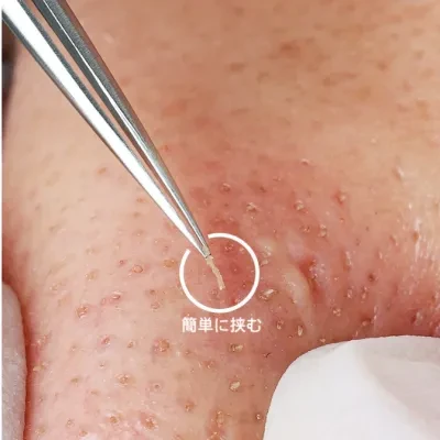角栓取り｜ステンレス鋼・にきびクリップ・ニキビツール・にきび除去・脂肪粒子の治療・ニキビ